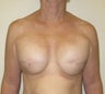 Breast Reconstruction