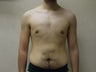 Male Breast Reduction