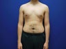 Male Breast Reduction