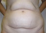 Tummy Tuck