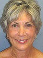 Neck Lift on 65-year-old