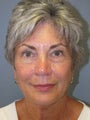 Neck Lift on 65-year-old