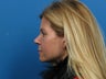 Revision Rhinoplasty