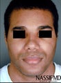 African American Male Rhinoplasty 