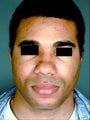 African American Male Rhinoplasty 