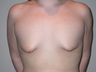 21 year old with severe tuberous breast deformity