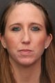 30 Year Old Young Lady Treated with Botox for the Creases of her chin