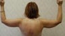 Arm Lift