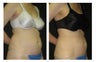 Liposuction