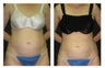 Liposuction