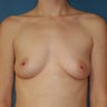 Breast Implants Augmentation Enlargement Enhancement