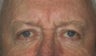 Brow and lid ptosis surgery