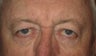 Brow and lid ptosis surgery