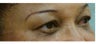 Woman in her 60s treated for dark circles and fine lines with Enerpeel EL eyelid peel