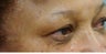 Woman in her 60s treated for dark circles and fine lines with Enerpeel EL eyelid peel