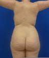 Brazilian Butt Lift