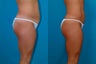Liposuction