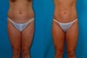Liposuction