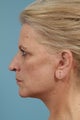 Neck Lift
