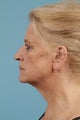 Neck Lift