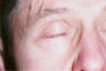 Lid Lesions