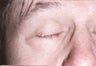 Lid Lesions