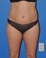 Liposuction