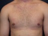 21 Year Old Male Treated for Gynecomastia