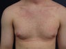 21 Year Old Male Treated for Gynecomastia