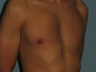 VASER LipoSelection performed on his chest.