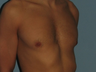VASER LipoSelection performed on his chest.