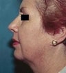 46 year old female patient 