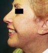 46 year old female patient 