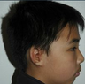 Microtia aka small Ear