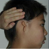 Microtia aka small Ear