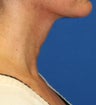 Submental Necklift