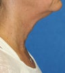 Submental Necklift