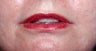 Lip Augmentation