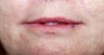 Lip Augmentation