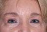 75 Year Old Female Treated For Sagging and Asymmetric Brows