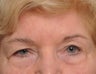 75 Year Old Female Treated For Sagging and Asymmetric Brows