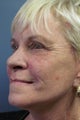 Chemical Blue Peel &Lite Lift