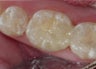 Getting Tooth Colored Fillings