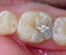 Getting Tooth Colored Fillings