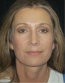 Brow Lift with Facial Fat Grafting