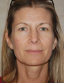 Brow Lift with Facial Fat Grafting