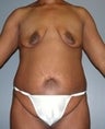 Female patient who received surgery after major weight loss 