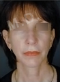 Complete Facial Rejuvenation