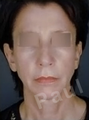 Complete Facial Rejuvenation