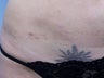 Scar Revision with fat transfer